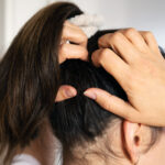 Itchy Scalp remedies