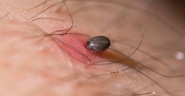 Top Lyme Disease Lyme Tick Removal